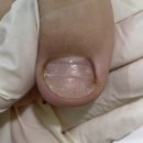 경산내성발톱 교정 전문 대구 모모뷰티앤발톱전문가