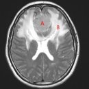 ﻿뇌부종 (cerebral edema) 이미지