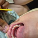 율하예미송키즈치과의원 | 6세 남아 유치 발치/유치 변색(발치시기순서,발치 후 관리,소아치과)