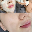 쥬베룩 스킨부스터청담피부과 후기 통증 효과 비교 전후 정리