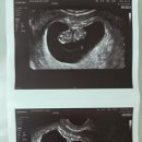 마음톡의원 | [임신 8주~11주] 분만병원 결정(루트여성의원), 1차 기형아검사&amp;입체초음파 후기