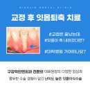 하단역 치과 잇몸이식 수술 비용 통증 후기