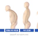 척추전만증 척추측만증 증상 차이 교정 운동법 이미지