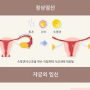 자궁외임신 증상 및 원인과 수술 통증 임테기 이미지