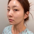 홍대피부과/덴서티 하이 600샷/효과/가격/10일 차 후기