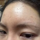 까까머리 | 모발이식 2~7일차 경과 리얼후기ㅣ통증,붓기,각질 회복 과정