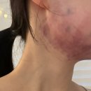 브리에의원 | 압구정 브리에 의원 인모드 FX 멍 빼기 프로젝트, 멍크림이 답이었구만