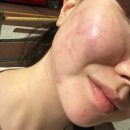 자방모드 | 창원피부과 웨딩관리 예비신부 시술 추천 인모드 후기