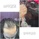 모자티헤어증모 | 대전증모가발 원조