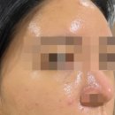 서면피부관리 서면아쿠아필 전포피부관리 : 예쁘리