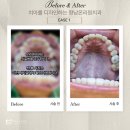 아이러브다이아몬드치과의원 | 인비절라인퍼스트 후기, 비용 총정리 (초등학생 투명교정)