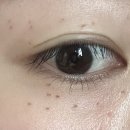 성지빌딩 | 편평사마귀 성지 이삭가정의학과 제거 후기 가격 취소표 1~3일차