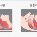 코골이원인 수면무호흡증으로 인한 저산소증 증상 이미지