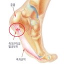 족저 근막염 원인 증상 치료방법, 발바닥 스트레칭 이미지