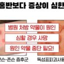 감기약 먹고 온몸 발진 후 사망? 독성표피괴사융해증의 모든 것 이미지