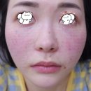 슈링크리프팅 유니버스 600샷+쥬베룩스킨부스터 4cc 손주사 후기!
