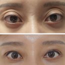 아이브성형외과의원 | 쌍수하면 대박나는 눈! _속쌍꺼풀,매몰,찝기,겹쌍꺼풀,인라인,앞트임
