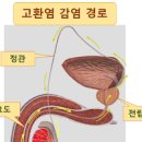 고환염 , 부고환염 (왼쪽 고환 통증, 음낭 부종, 발열) 이미지