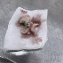 오제석치과의원 | [오제석치과 후기1] _ 광주 오치동 사랑니 발치 전문 치과, 매복사랑니 발치 후기