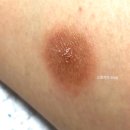 금당약국 | [블챌] 에어컨 안켜서 모기 알레르기 받고 모낭염 더블로 나는 일상(모낭염성지글)