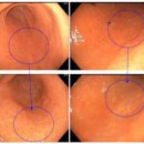 위축성위염 제균치료해도 꾸준히 관리안하면 재발됩니다 이미지