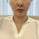 레드튠 | 얼굴주름리프팅 튠페이스 블루 레드 LDM 관리 효과 전후비교 상세후기
