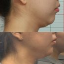 평촌큰한의원 | (내돈내산) 가로세로한의원 평촌점 슈링크리프팅 600샷 한달 후기