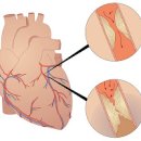 심장 협심증 원인 증상 치료법까지 이미지