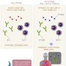 M35 결합조직의 기타 전신침범 Other systemic involvement of connective tissue 이미지