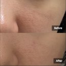 상미초등학교 | 부천 신중동 피부관리 모공 에어플라즈마