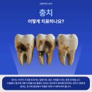 이오균치과의원 | 영등포 충치치료 치과 충치 어떻게 치료하나요? 당산동치과