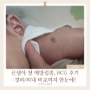 두리메디칼 | 검단 BCG 접종 후기 피내용 vs 경피용 비교 흉터 경과