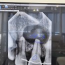 전북대학교치과병원 | 치아 뿌리에 물혹이 생겼어요 치근단수술 과정 붓기 통증 후기