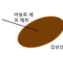 갑상선 비정형 세포 이미지