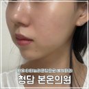 청담봄온의원 | 볼살많은얼굴 청담 봄온의원에서 티타늄리프팅 80KJ 받은 후기