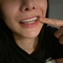 수원 라미네이트 치과 이갈이장치 스플린트 1년 반 솔직 후기 효과 가격까지!