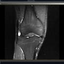오른쪽무릎 반월상연골판 파열 진단을 받았습니다. 이미지