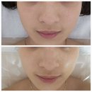 군산 레이드 스킨 닥터메카 콜라겐 리프팅 후기