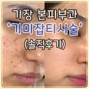 기장 본피부과의원에서 기미/잡티 레이저 시술 후기