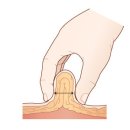 지방 흡인술[liposuction] 이미지