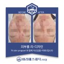 건강하게롱런하시게 | 구미 여드름 관리 있어서는 아라에스테틱