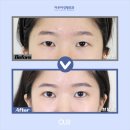 시원한의원 | 꼬막눈 탈출 - 비절개 쌍꺼풀, 앞트임, 뒤밑트임으로 시원한 눈 만든 후기