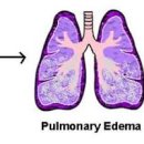 폐에 물이 차는 이유와 폐에 물이차면 생기는 증상 : 폐부종 증상 및 치료 이미지