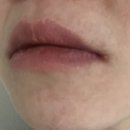 톡스 | 입술물집 재발 헤르페스 영양제 라이신 헤르톡스 후기