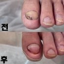 덕양 화정내성발톱 무좀관리 레푸스 관리후기