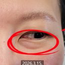 양이멍이 | 눈밑지방재배치 수술 2주차 후기 가격, 회복기간 통증 관리 꿀팁