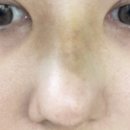 안코비어 | 코젤코 수술 후기 (2)