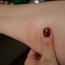 천지메디컬(CJ Medical) | [베트남 여행후기] 베트남 다낭에서 화상을! 호이안 퍼시픽 병원 이용후기