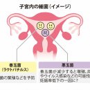 불임치료로 주목 받는 '자궁내 플로러'. 장미빛만은 아닌 현실. 이미지