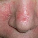 지루성 피부염 뺨, 코, 이마 붉은 반점은 왜 생길까 이미지